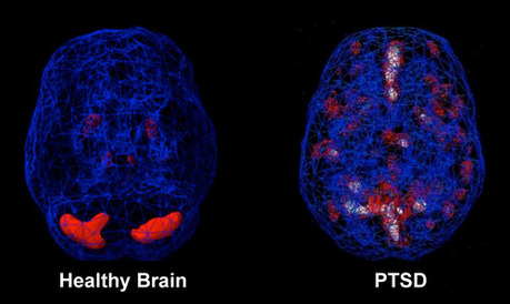 PTSD & the Brain - PTSD